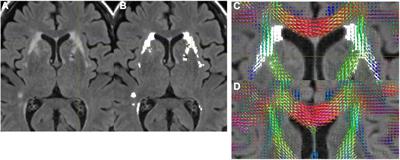 Tract Specific White Matter Lesion Load Affects White Matter Microstructure and Their Relationships With Functional Connectivity and Cognitive Decline